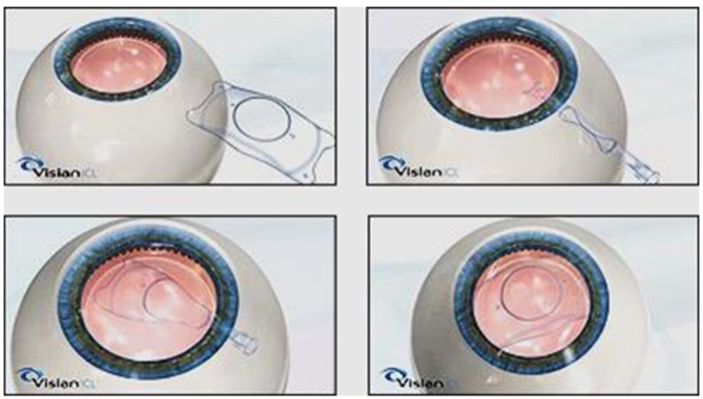 admin/image/ICL-surgery-schematics.jpg